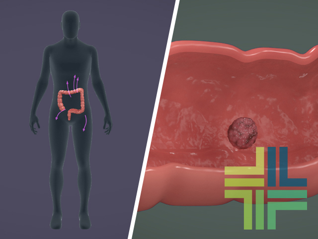 Colorectal Cancer Prevention UIC